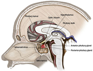 Brain Tumors