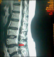 Minimally Invasive Spine Surgery (MIS)